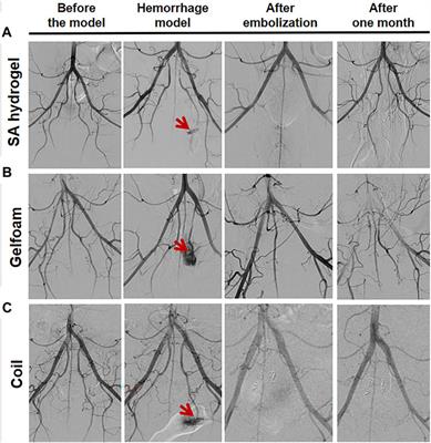 Application of modified sodium alginate hydrogel for interventional embolization of hemorrhagic diseases